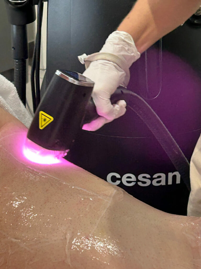 épilation définitive laser Montpellier