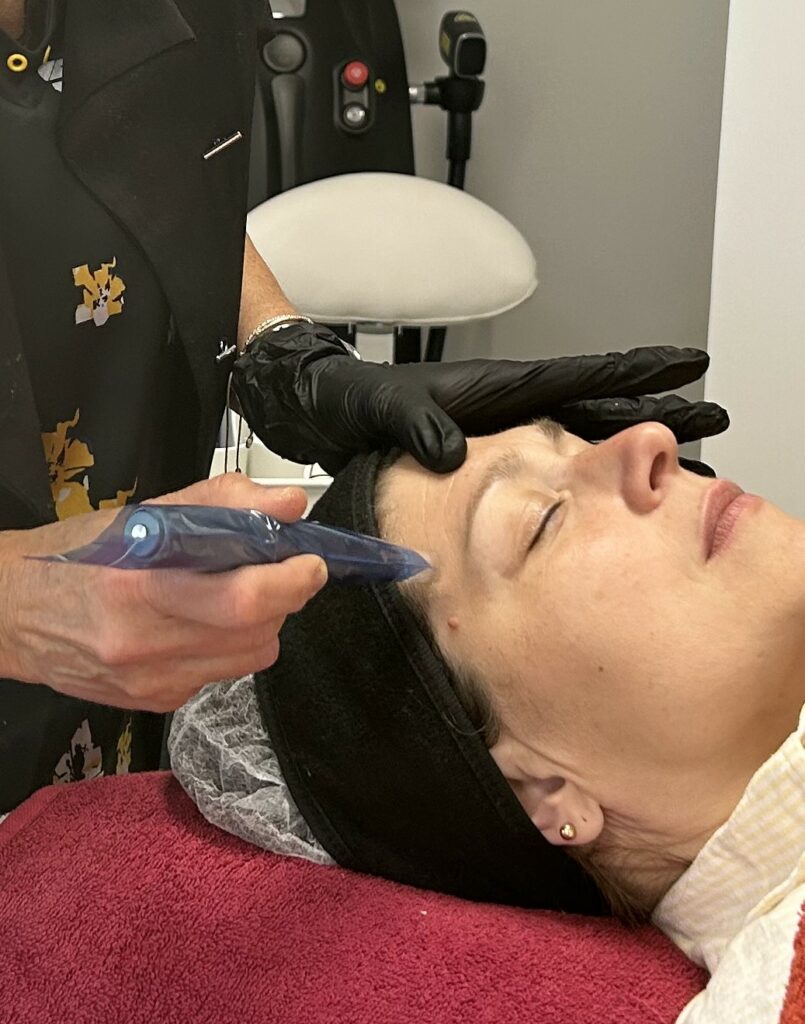 nano needling montpellier